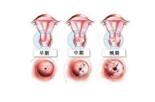 女子与男友恋爱后感染三种高危HPV女子与男友恋爱后感染三种高危HPV，警醒爱情背后的健康隐患